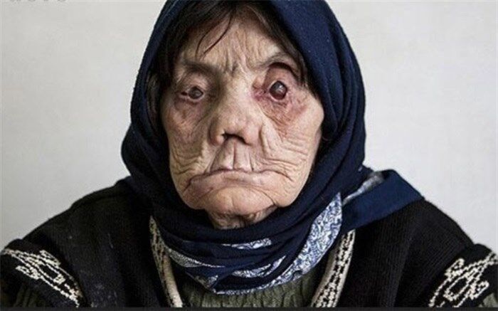 20 هزار نفر در سال به جذام مبتلا می‌شوند