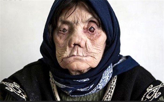 20 هزار نفر در سال به جذام مبتلا می‌شوند