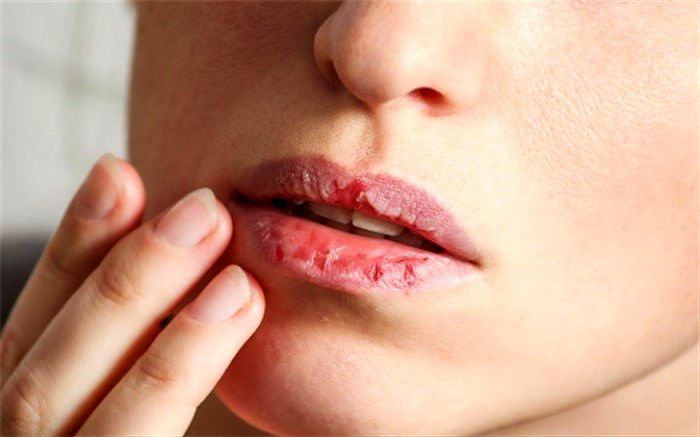8 دلیل خشکی لب‌ها