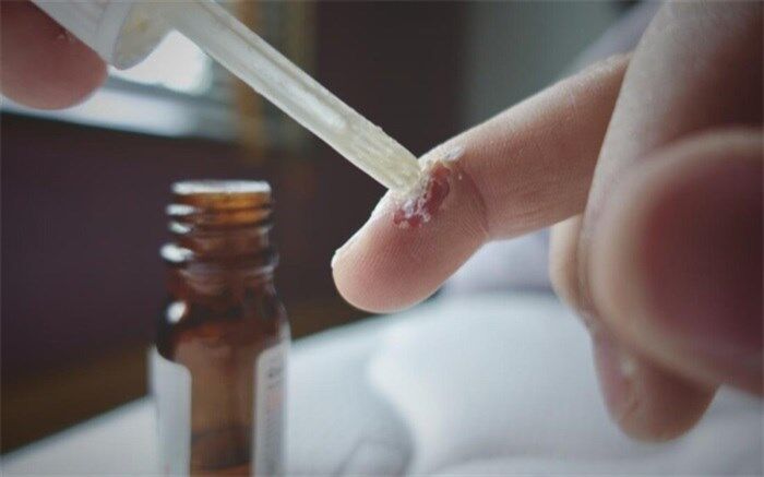 نکته بهداشتی: خلاص شدن از زگیل