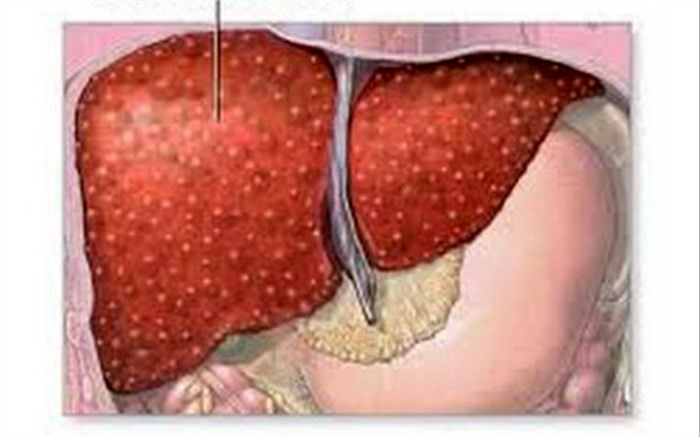 مهم‌ترین علل بروز «تنبلی کبد» چیست؟