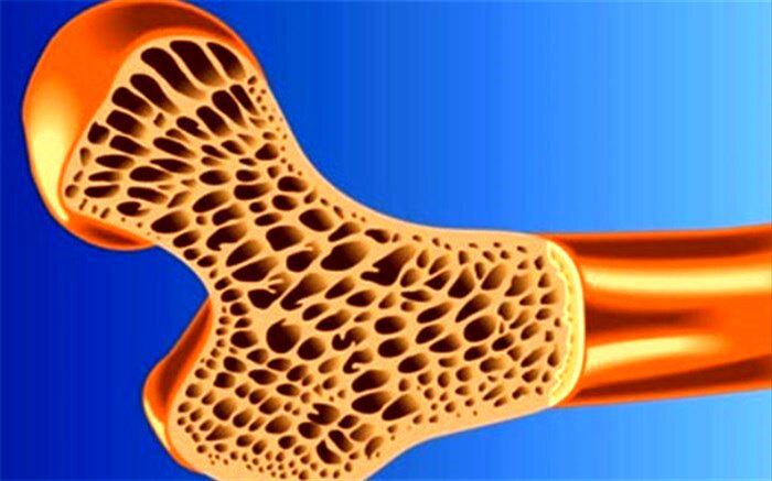 تاثیر دوز مصرفی داروی استاتین بر ریسک ابتلا به پوکی استخوان
