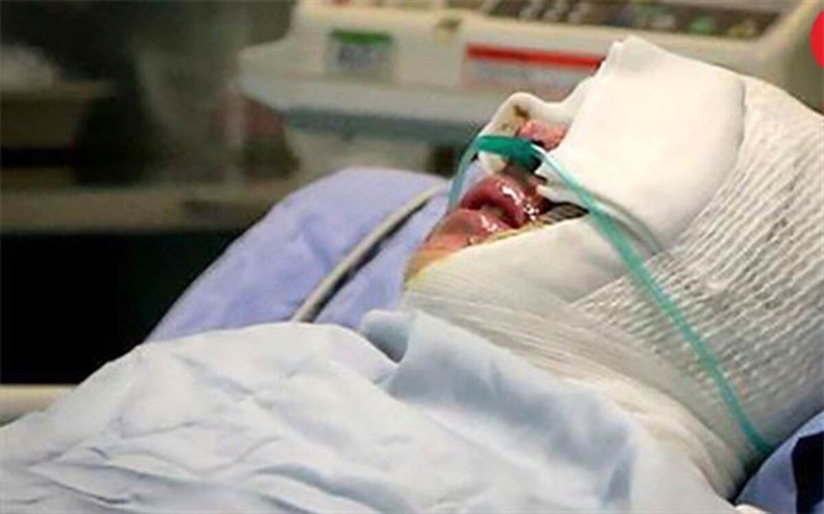 اسیدپاشی وحشتناک مرد بدبین
