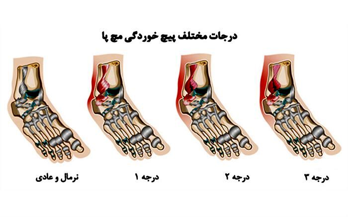 پس از پیچ خوردن مچ‌پا چه باید کرد