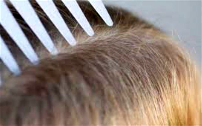 چطور شپشِ سر را از شوره تشخیص دهیم