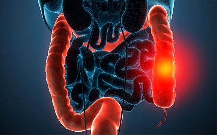 سرطان روده بزرگ و نکته‌هایی برای پیشگیری