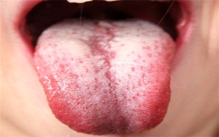 سفیدی زبان و دلایل شایع آن