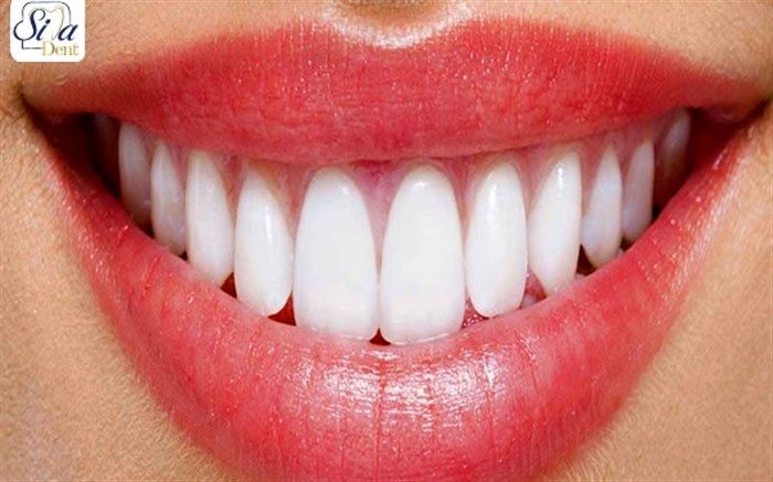 متداول ترین روش اصلاح طرح لبخند