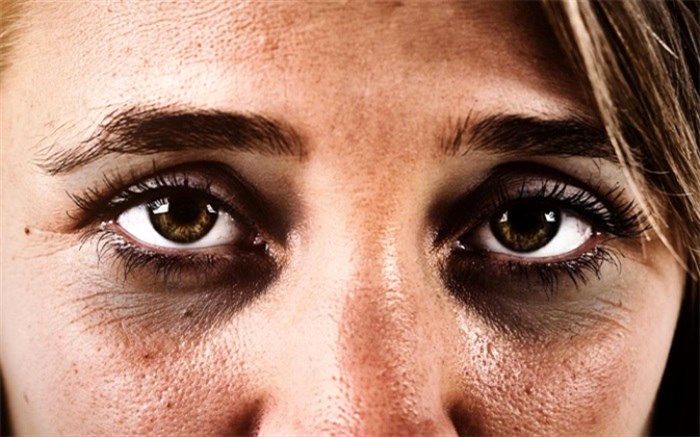 حلقه‌های تیره زیر چشم و روش‌هایی طبیعی برای بهبود آن