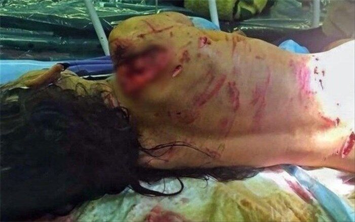 آخرین وضعیت دخترک گلفروش که مورد حمله سگ‌ها قرار گرفت