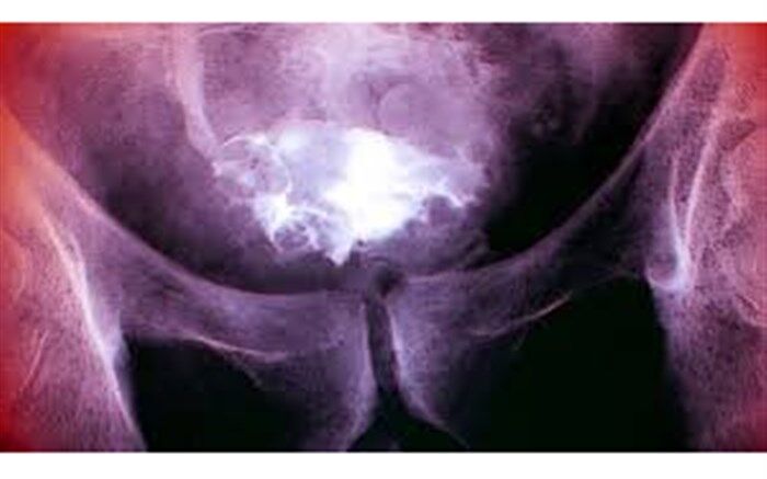 دستاورد محققان ایرانی؛ تشخیص سرطان مثانه ۱۰ سال قبل از بروز