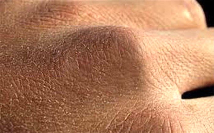 راههای مقابله با خشکی پوست دست در روزهای کرونایی