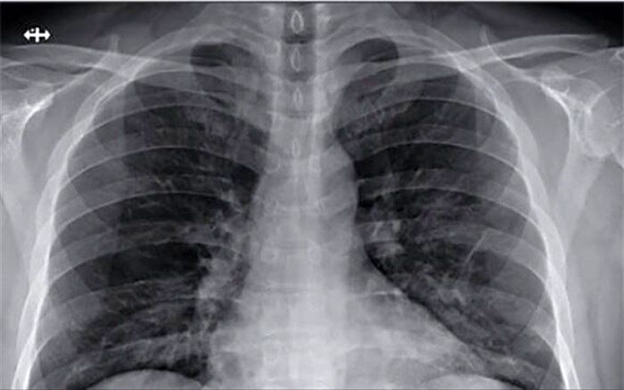 کرونا چه بلایی بر سر ریه‌ها می‌آورد؟