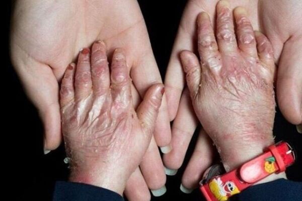 بیماران نادر؛ قربانیان وعده‌های تکراری و صندوقی که هنوز شفاف نیست