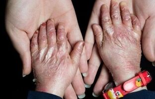 بیماران نادر؛ قربانیان وعده‌های تکراری و صندوقی که هنوز شفاف نیست