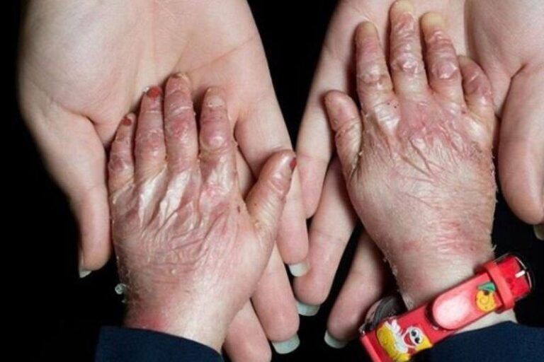 بیماران نادر؛ قربانیان وعده‌های تکراری و صندوقی که هنوز شفاف نیست