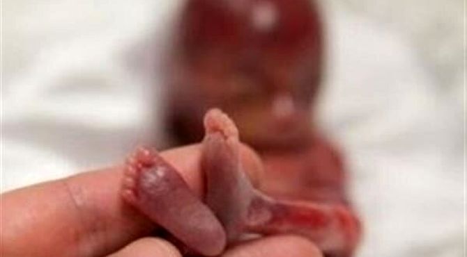 حدود ۳۰ درصد بارداری‌ها خودبه‌خود پایان می‌یابد